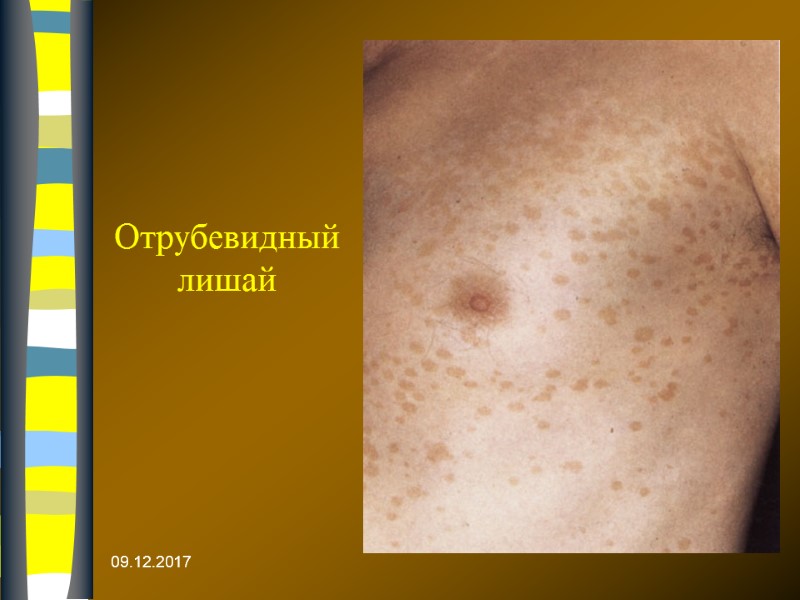 09.12.2017 Отрубевидный лишай